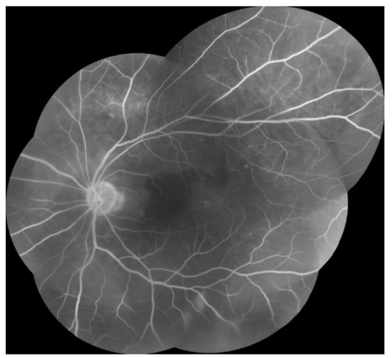 After initiation of RIPE therapy and surgical repair of the retinal detachment with silicone oil tamponade, color fundus photograph reveals improvement of choroidal lesions.