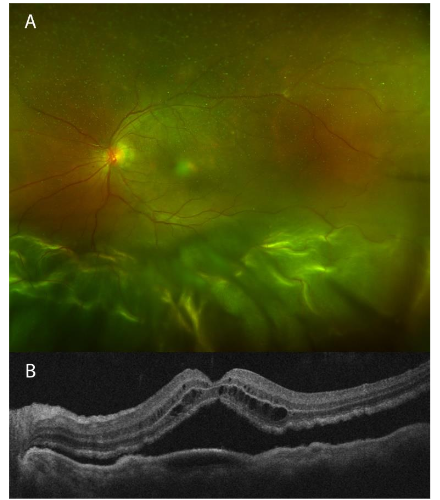 After completion of RIPE therapy and removal of silicone oil, color fundus photograph reveals continued resolution of choroidal lesions.