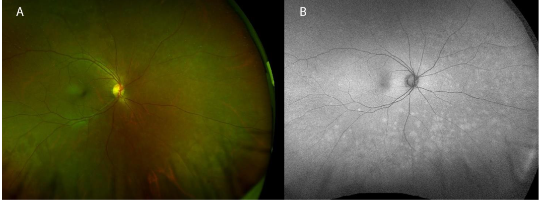 Fundus autofluorescence highlights the choroidal lesions as hyper-autofluorescent.