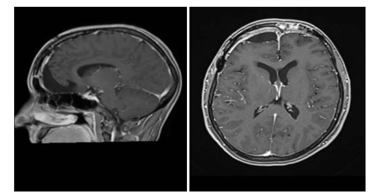 Figure 2. Postoperative Magnetic Resonance Imaging in sagittal and axial sections, showing complete resection of the meningioma.