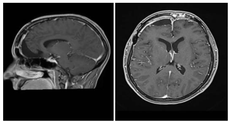 Figure 2. Postoperative Magnetic Resonance Imaging in sagittal and axial sections, showing complete resection of the meningioma.