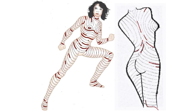 Recommended surgical incisions along the main folding lines (MFL) with sparing major cutaneous nerves and vessels, of course.