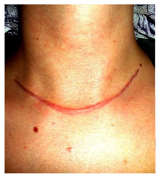Typical collar over the sternal notch may leave a hypertrophic scar. The thyroid is easier approached through an incision in the lower cervical fold.
