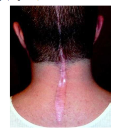 In young patients, vertical incisions in the dorsal neck may develop hypertrophy since the folding lines run horizontally. Above the scapula, however, they run vertically.