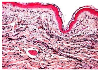 A skin fold with reduced collagen fibers underneath, running parallel to the fold and cut perpendicularly to the fold. Elastic fibers (black) are running diagonally to the fold.