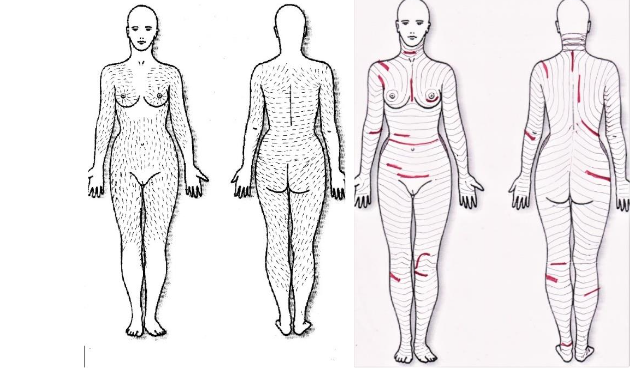 A compound of striae lines collected from 213 photos of patients with different underlying etiology. The resulting Folding (MFL) run perpendicular to the striae lines.