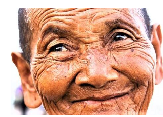 If all patients would present with those clear folding lines, the choice of skin incisions would be easy.