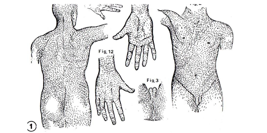 Some run oblique or perpendicular to the recommended Folding on forehead, lower abdomen, buttocks and extremities Langer´s cleavage lines run parallel to the Folding over neck, shoulders, upper abdomen and back and therefore correctly in the direction of the proposed.