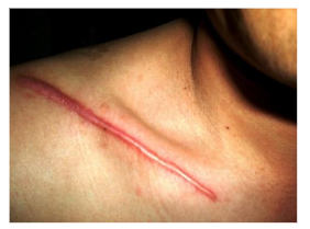 This typical hypertrophic scar after fixation of a clavicle fracture could have been prevented with a shorter vertical incision in the main folding lines.