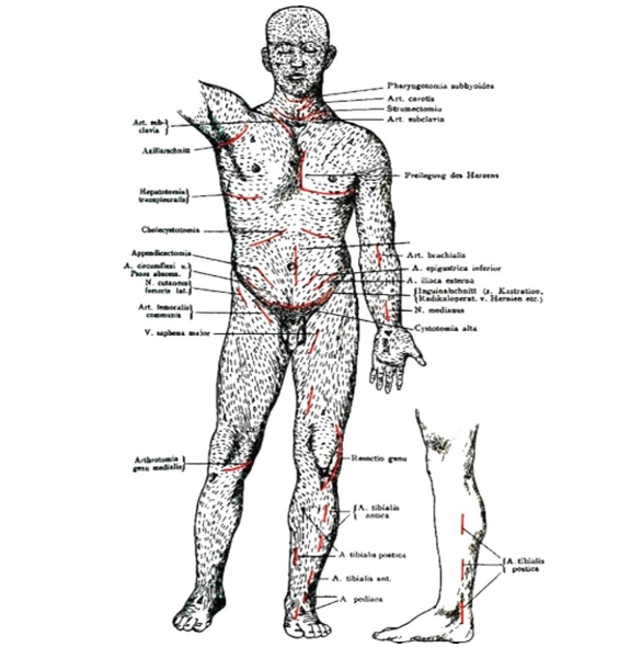 Kocher recommended cleavage for all surgical excisions and incisions. However, Especially on extremities of children and adolescents, lengthwise running scars often become hypertrophic.