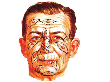 Folding in the face and the logical directions of excisions (drawings by Frank H. Netter 1994).