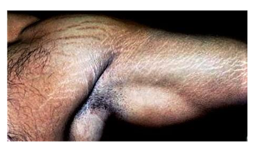 Striae in a body builder and a Cushing patient run parallel to the direction of the muscle bundles: therefore, all incisions on extremities should be made oblique but not interfere with major nerves and arteries.