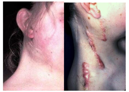 Proof of our recommendation in a corrected with two Z-plasties on each side. The scars within the neck´s horizontal folding lines are almost invisible; those perpendicular (vertical) to them became hypertrophic.
