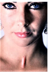 Very obvious vertical tracheotomy scar against folding of actor Elizabeth Taylor.