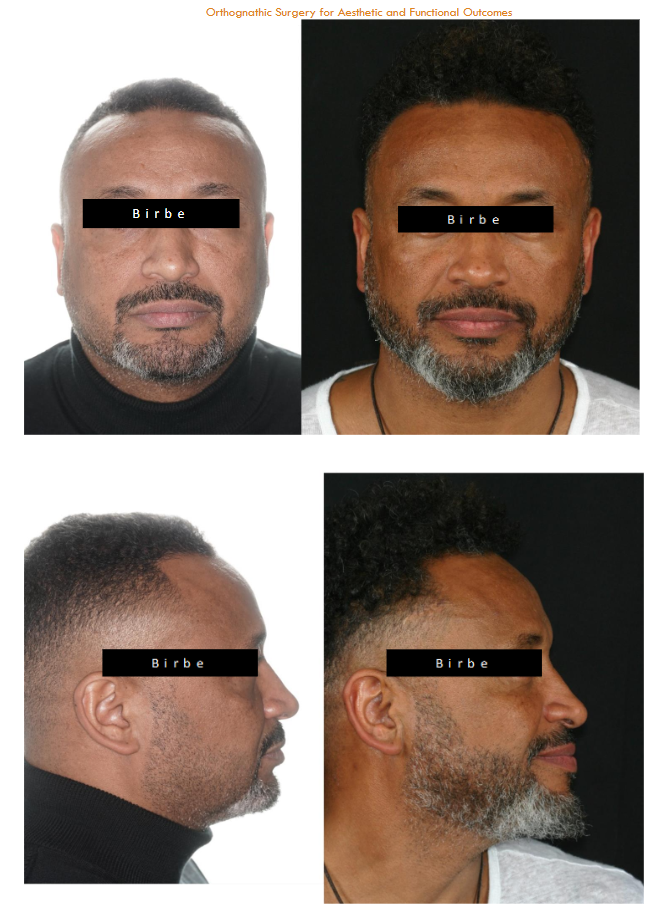 Pre and postoperative facial change on a Maxilo-mandibular advancement patient for OSAS front view and profile view.