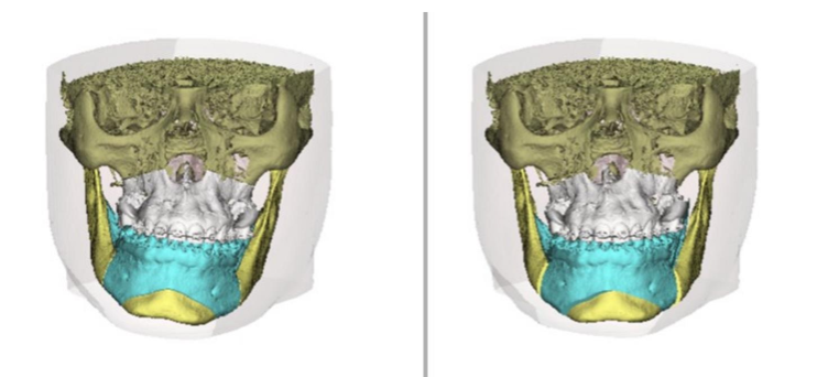 Virtual Surgical planning showing Lefort I osteotomy in the maxilla and Bilateral sagittal split osteotomies in the mandible with genioplasty.