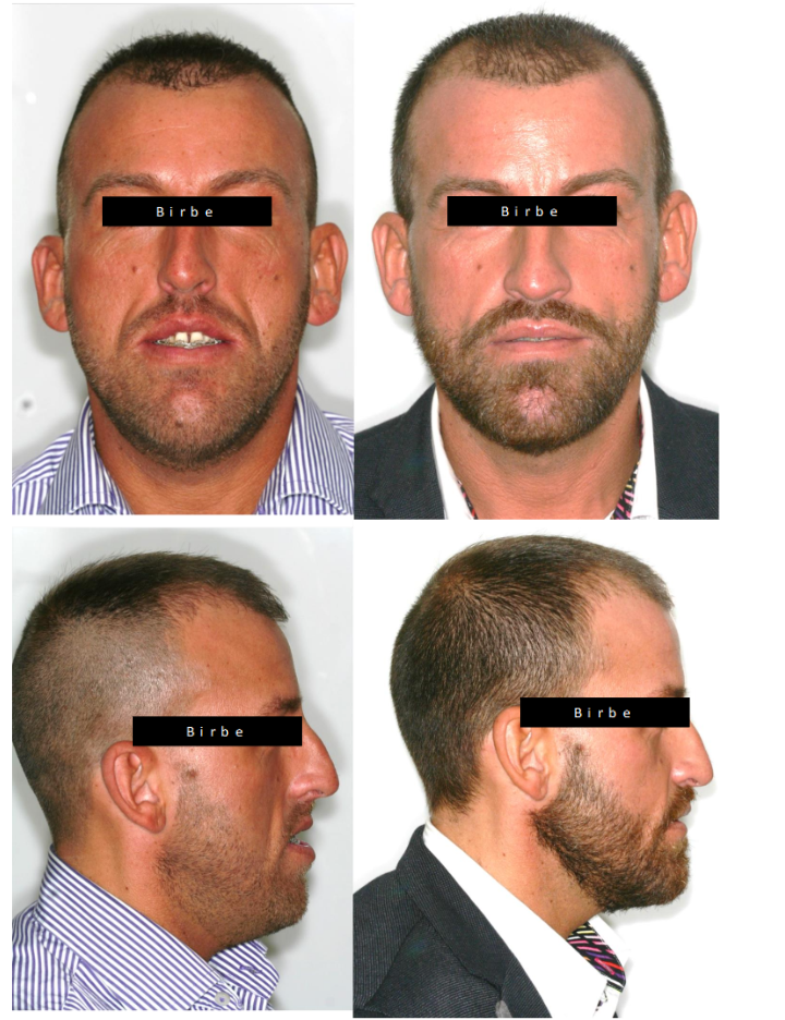 Orthognathic surgery enhancing masculine facial traits with bimaxillary advancement and genioplasty osteotomies.