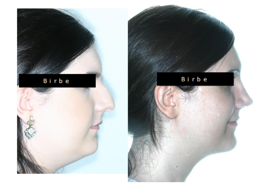 Facial Feminization Surgery FFS front and profile view with skeletal structural facial changes.