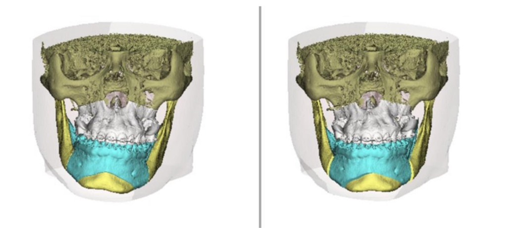 Virtual Surgical planning showing Lefort I osteotomy in the maxilla and Bilateral sagittal split osteotomies in the mandible with genioplasty.