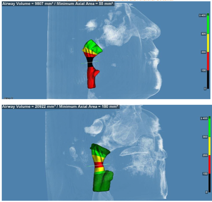 Preop (above) and postop (below) airway reconstruction of a patient that had bimaxillary advancement for OSA treatment. The volume airway increase is more than 50%.