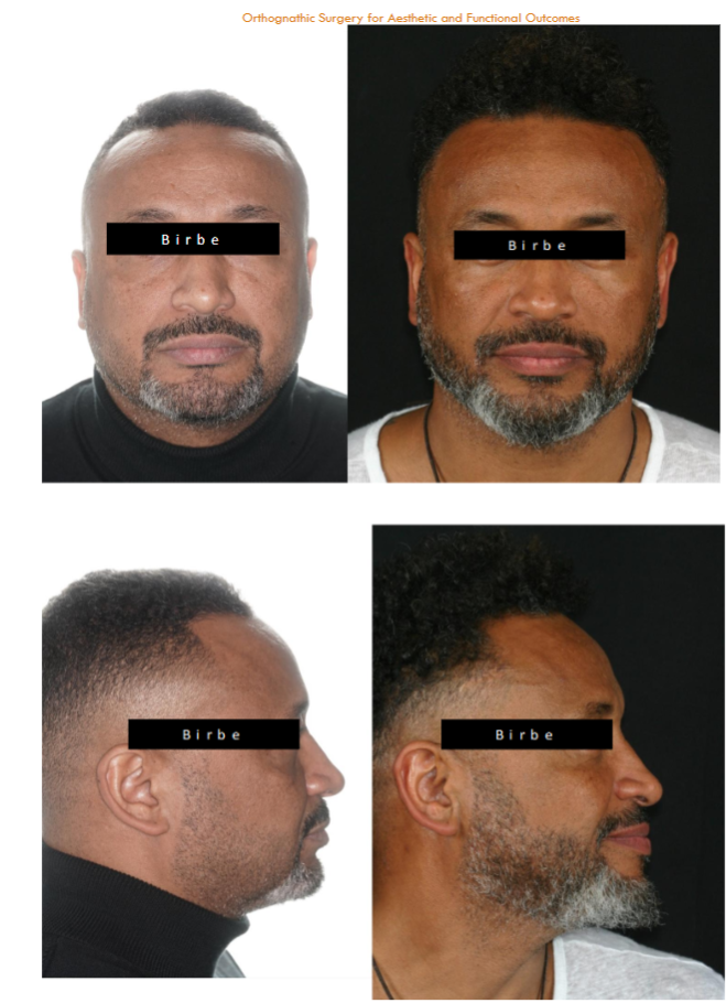 Pre and postoperative facial change on a Maxilo-mandibular advancement patient for OSAS front view and profile view.