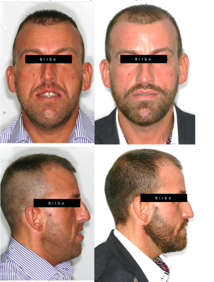 Orthognathic surgery enhancing masculine facial traits with bimaxillary advancement and genioplasty osteotomies.