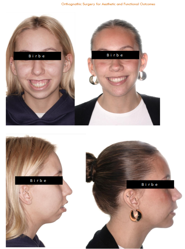 Preop (left) and postop (right) changes of a pacient with lip incompetence, ineffective pogonion, mandibular hypoplasia with that had a feminizing maxilo-mandibular advancement with counterclockwise rotation, and a genioplasty and rhinoplasty as ancillary simultaneous procedures.