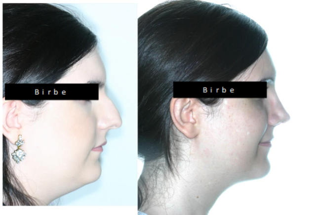 Facial Feminization Surgery FFS front and profile view with skeletal structural facial changes.