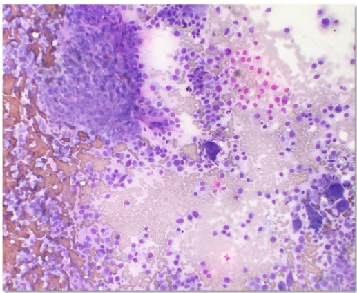Figure 1: Cytologic description of osteosarcoma.