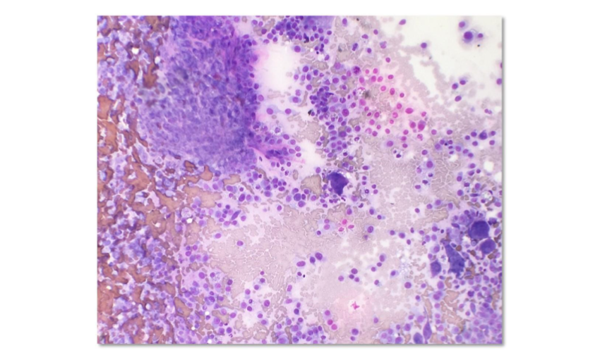 Figure 1: 12-year-old, intact male, Collie dog that presented with a right hind limb lameness. High nucleated cellularity. Low power view at 40x objective, Wrights stain.