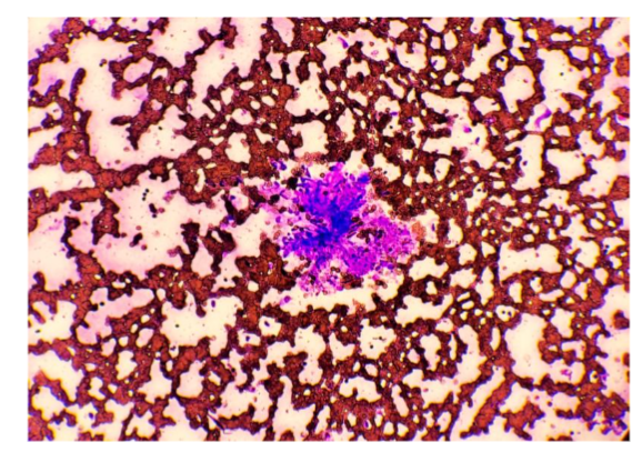 Figure 4A: 7-year-old, spayed female Bull Mastiff. Fine-needle aspirate biopsy cytology displaying clotted nucleated cells, non-diagnostic sample. Low power view at 20x objective, Wrights stain.