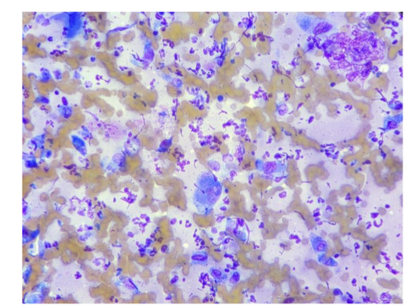 Figure 4B: 7-year-old, spayed female Bull Mastiff. Fine-needle aspirate biopsy cytology displaying high nucleated cellularity. Many degenerate neutrophils and rare eosinophils are seen. Low power view at 20x objective, Wrights stain.
