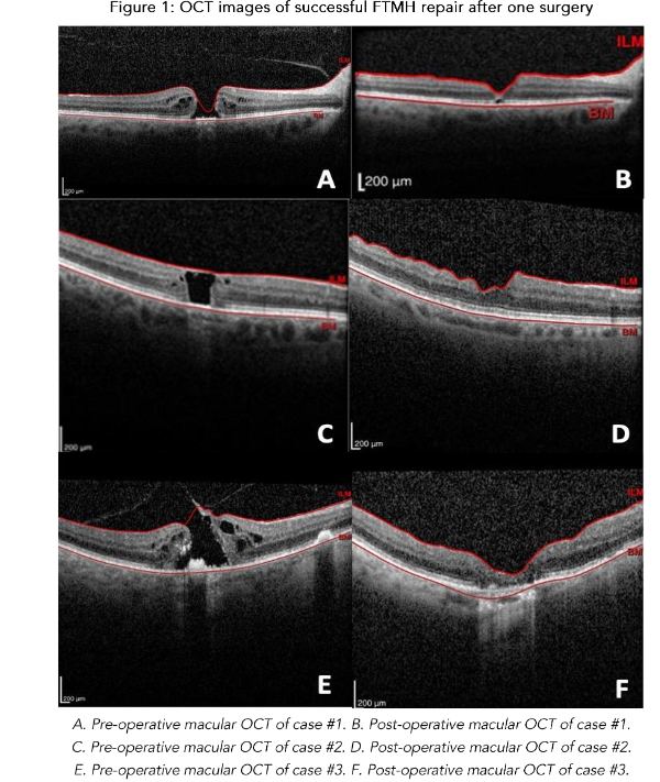 Figure 1: OCT images of successful FTMH repair after one surgery.