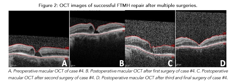Figure 2: OCT images of successful FTMH repair after multiple surgeries.