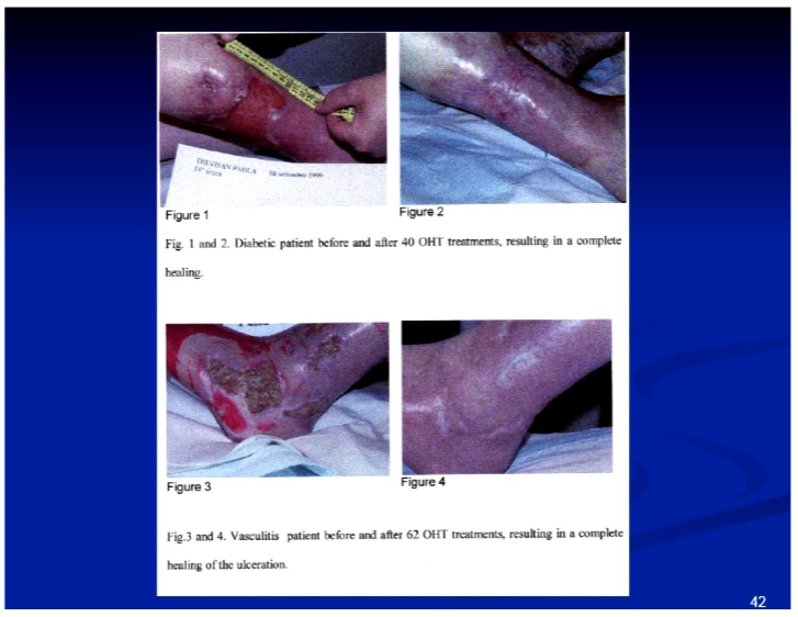 Ebola Virus Treatment with Ozone