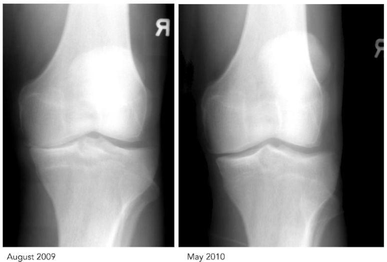 Mechanism of Ozone Therapy