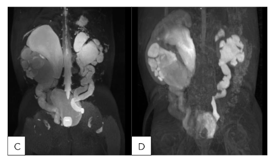 Figure 1: Representative MRU in Pediatric Patients with High-Grade Hydronephrosis