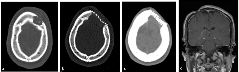 Lesion parameters in Surgical Patients