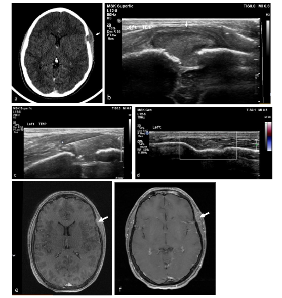 A case of a left temporal LCH lesion completely regressed following FNB in a female, aged 2 years old. a. Axial brain CT in soft tissue window shows a classic LCH lesion in the left temporal bone (white arrow). b. US image at the level of the lesion showing a soft tissue growth within a bone defect with beveled edge (white arrow). c. The biopsy gun (arrowhead) within the soft tissue bulge above the skull in tangential projection. d. Early post biopsy US showing complete regression of the soft tissue mass and healing of the bone with continuation of the skull (within cursor box). e. On MRI, an axial T1W image shows partial remodeling of the bone (white arrow) 3 months post FNB, and f. 3.5 years post FNB, with complete healing of the left temporal bone (white arrow).