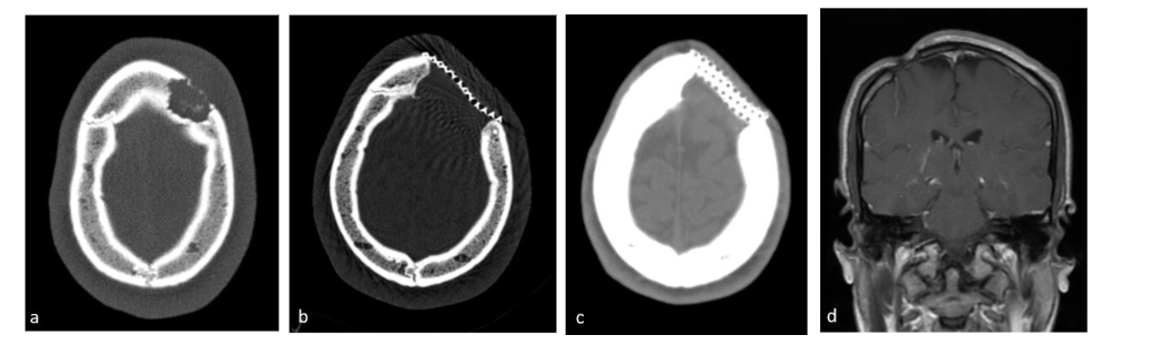 A suboptimal esthetic result post resection of a frontal LCH lesion in a male, aged 10 years old.