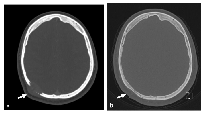 Complete regression of a LCH lesion post-surgical biopsy in a male, aged 18 years of age. Brain CT in axial plane and bone window shows a. a right parietal, classic LCH lesion (white arrow), b. Sixteen months later no lesion is seen and the bone healed, though a bit thinner than the rest of the vault (white arrow).