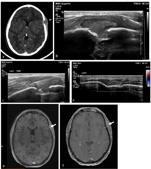 Lesion parameters in FNB patients