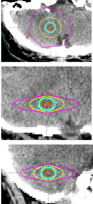 Isodose volumes are shown in axial, sagittal and coronal view. Corresponding volumes were 0.04, 0.28, 0.48, 0.77, 2.67, and 10.70cc.