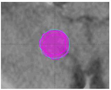 Volume variations after directly applying the "copy structures to registered image" function to different temporal point images.