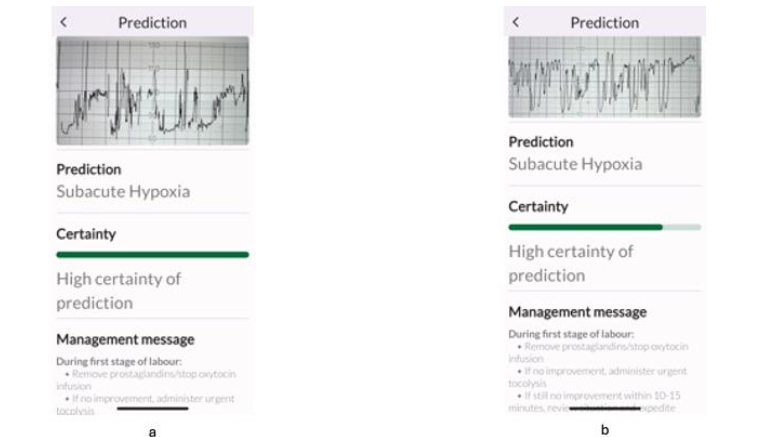 Note the smooth undulating waveforms characteristic of typical sinusoidal pattern, and sharp, pointed waveforms characterising the atypical sinusoidal pattern resembling the teeth of the shark, hence termed the “Poole Shark Teeth” pattern.