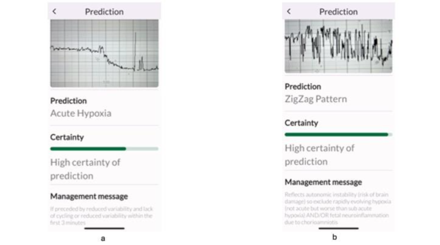 Features suggestive of a normal CTG (a) and chronic hypoxia (b) which were correctly identified by all the experts and TMA.