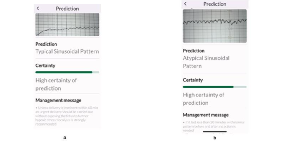 CTG features suggestive of a subacute hypoxic pattern (a), and subacute hypoxia with ZigZag pattern (b). The latter was classified by some experts only as “ZigZag” pattern.