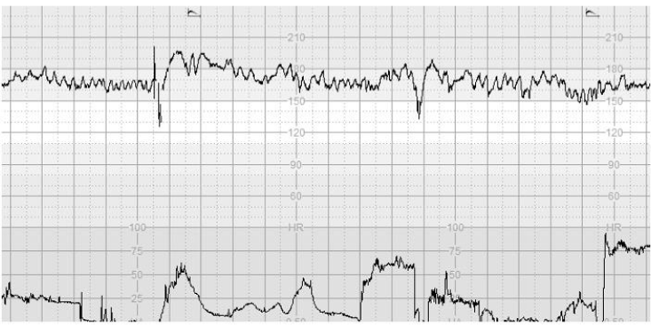 Figure 1: CTG traces illustrating 10% increase in the baseline FHR without repetitive decelerations and/or an increase in the baseline FHR.