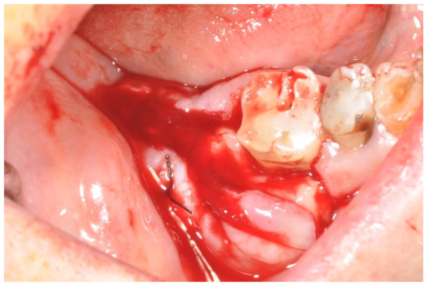 Filling of the cavity with PRGF-Endoret membranes that induced more bleeding.
