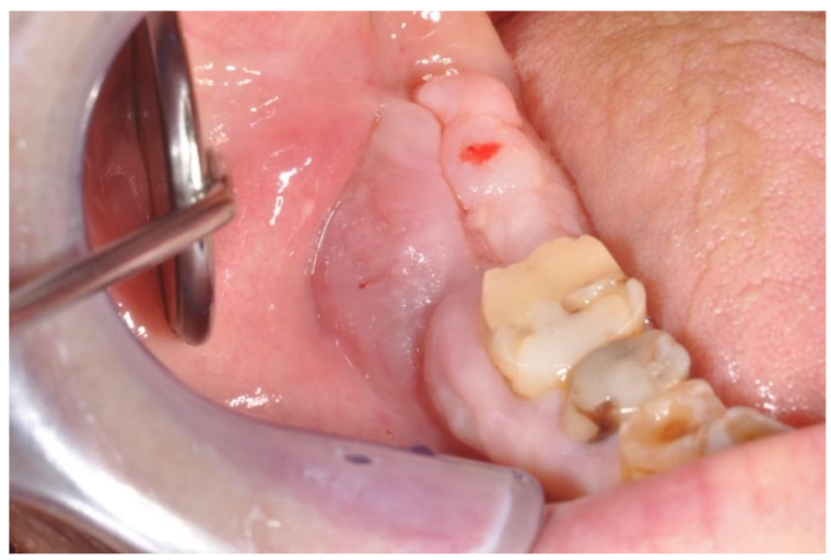 Intraoral aspect of the exophytic lesion at the level of the right mandible: in the middle a groove allows to approach the bone lesion.